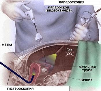Перекрытие труб у женщин камни в желчном пузыре лечение симптомы