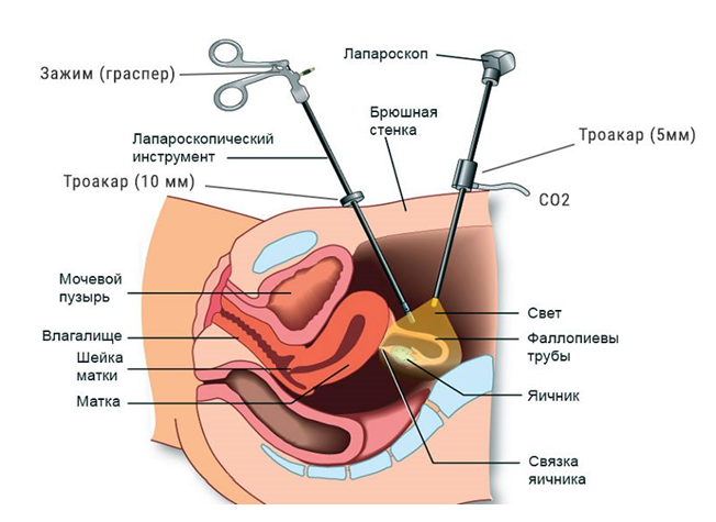 Лапароскопия кисты яичника калининград thumbnail